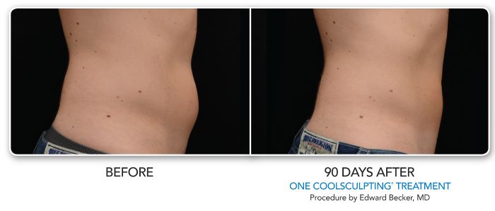 Before After CoolSculpting