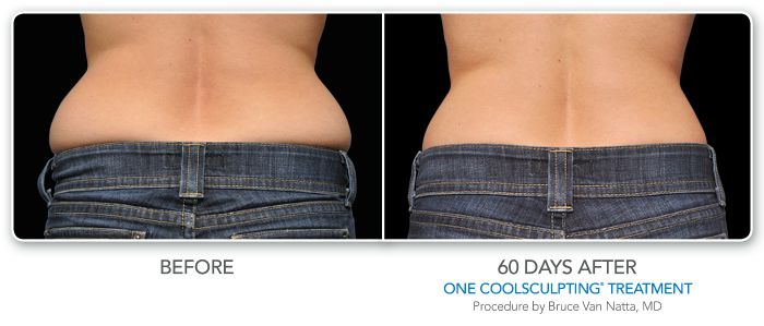 before and after coolsculpting back