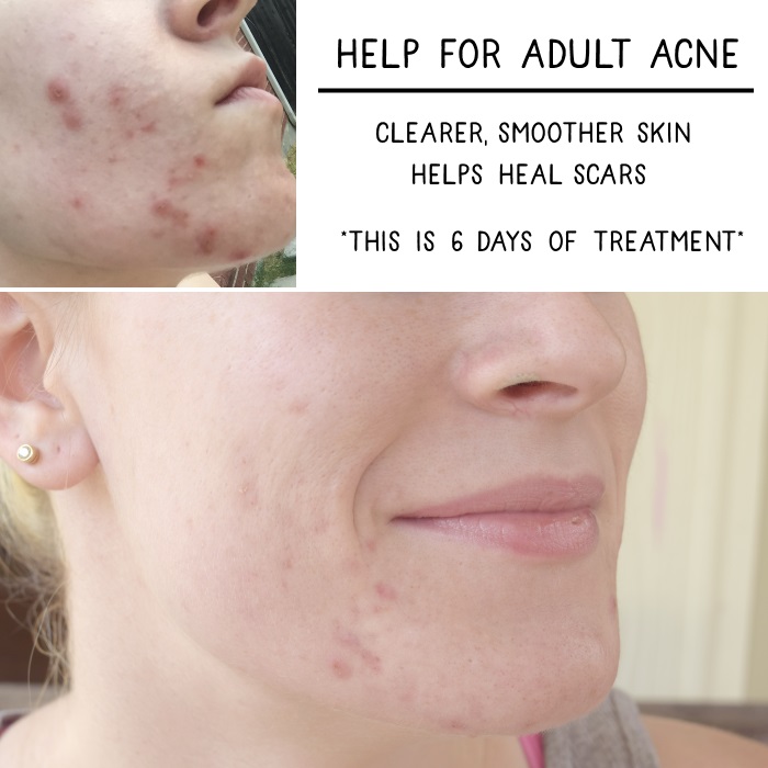 Help for Adult Acne