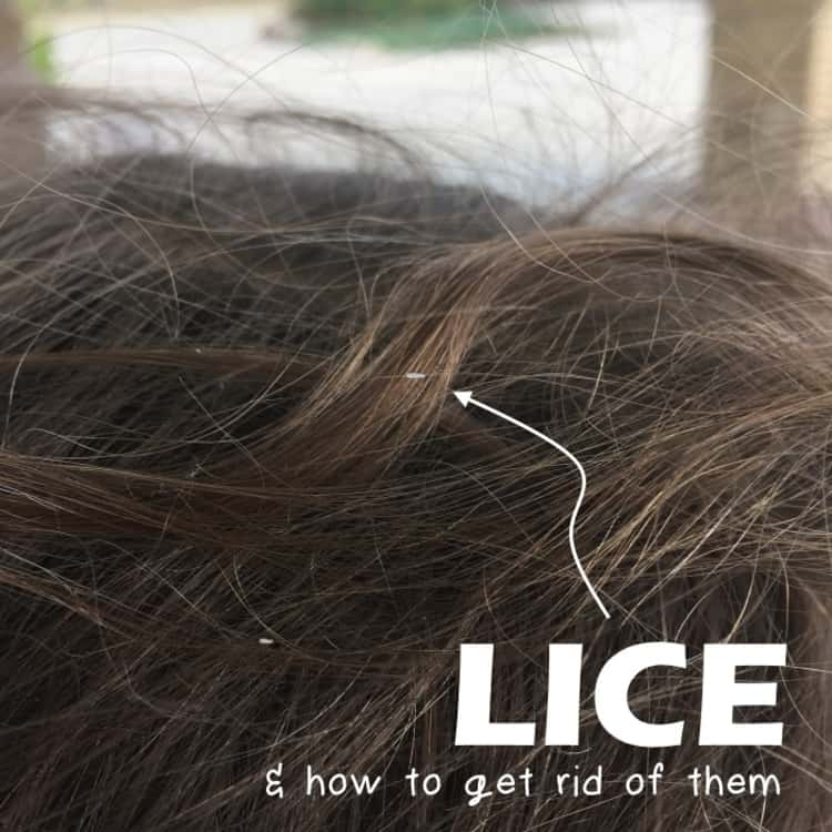 how to get rid of lice - child's hair with visible nits 