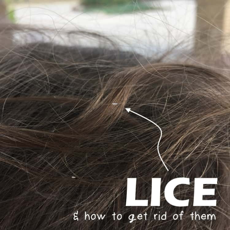 how to get rid of lice - child's hair with visible nits 