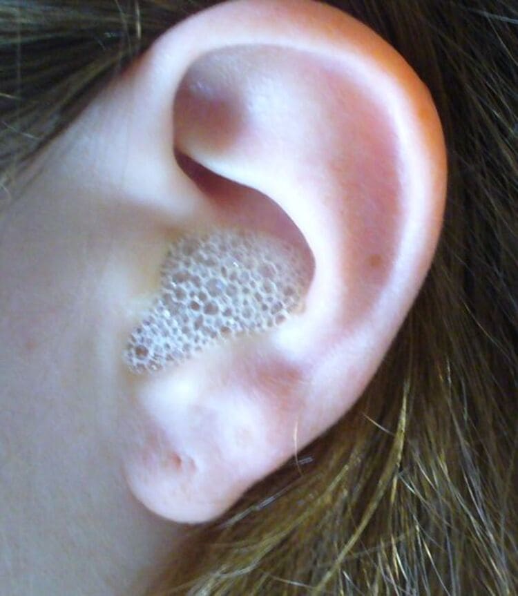 hydrogen peroxide cleaning on ears